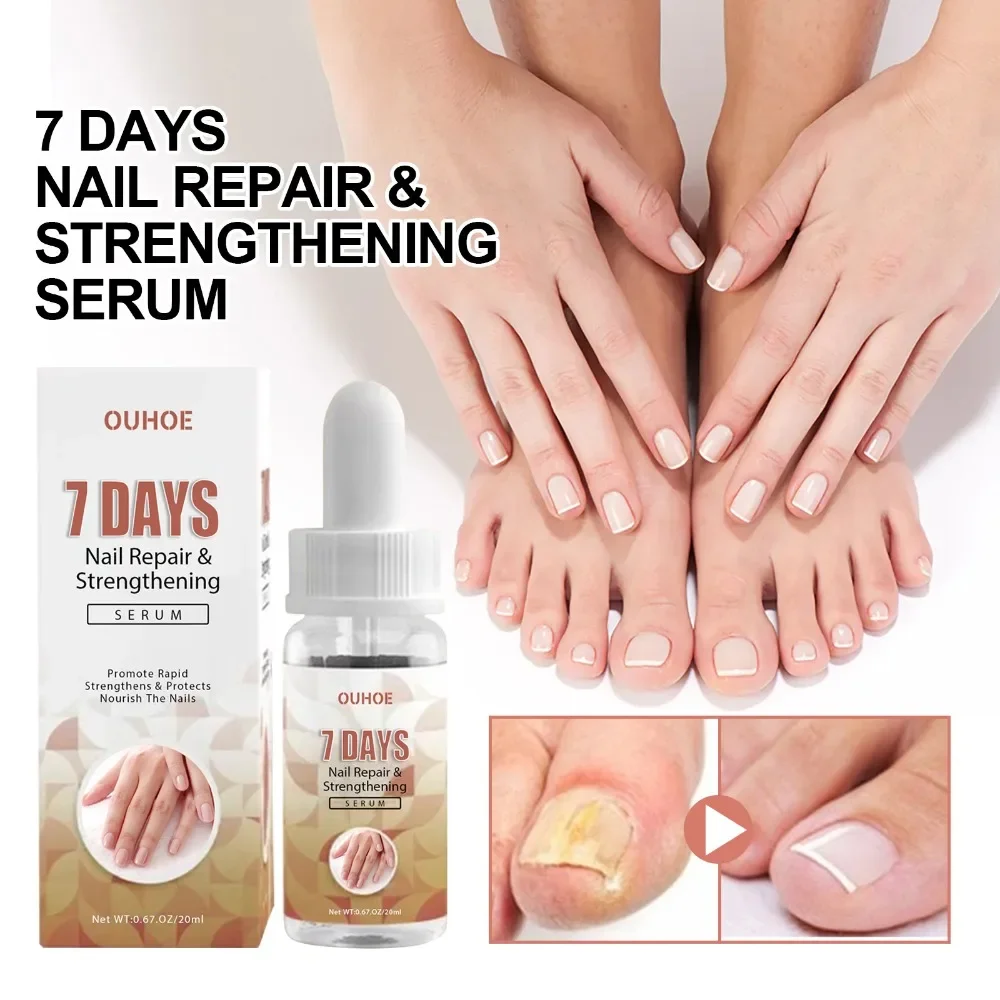 

uñas 1pc Repairing Serum Fine Good Durable Nails Repairing Serum Nourishing Nails Essence Nail Treatment Liquid 족저근막염 내성발톱