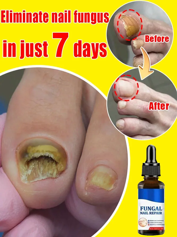 Fungus Solution The most powerful black technology in 2024! Completely solve the problem of fungus