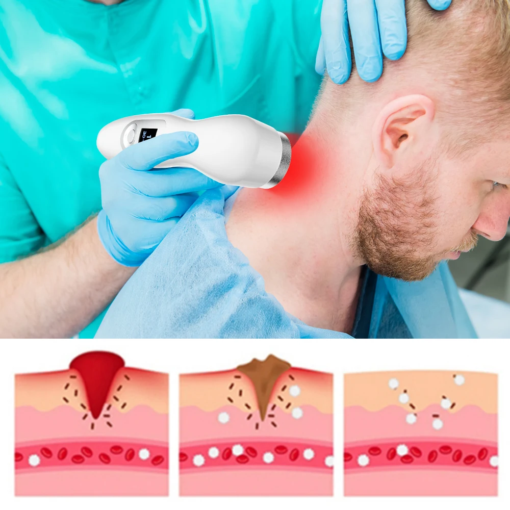 Suyzeko Kaltlaser-Therapiegerät, Pulsmodus, rotes Licht, Physiotherapie, Schmerzlinderung für Kniegelenk, Muskel, Körper, Heim- und Körperpflege