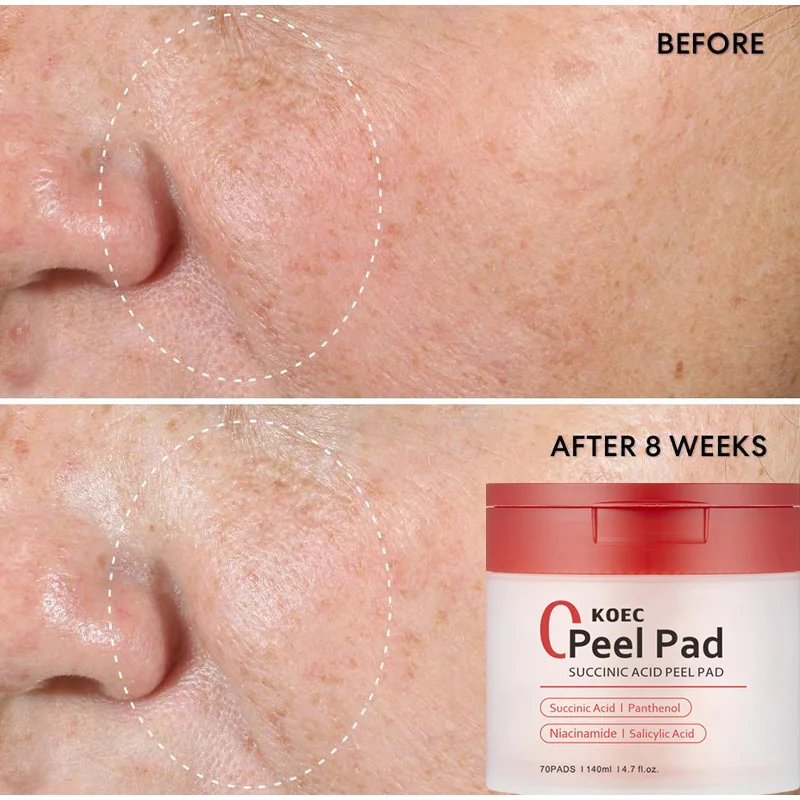 Amber Acne-removing Toner Cleansing Cotton Pads Acidic Panthenol Moisturizing Water Improves Acne Lightens Spots Facial Essence 4