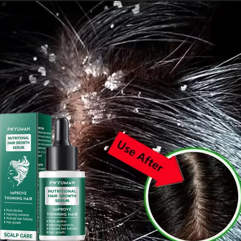 Hair Scalp Treatment Essence Spray Dandruff Itching Oil Control Anti Loss Scalp Cleaning Repair Serum Beauty Hair Care Products hair treatment scalp treatment