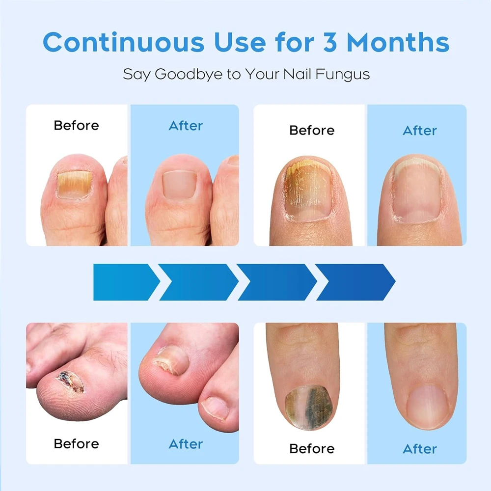 Nail fungus remover Nail Fungus Laser Treatment Device Fingernail Fungus Treat Onychomycosis Therapy Effectively Remove Onychomycosis Grow Toe Nail