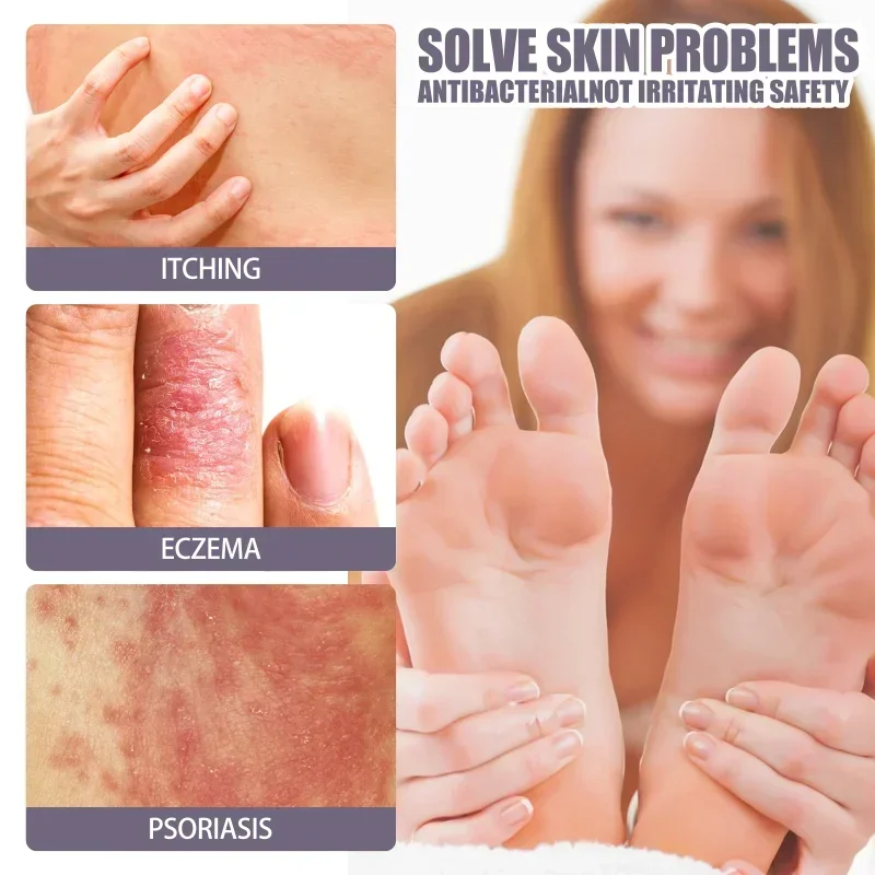 Hand Tinea Foot Odor beriberi spray Eczema Psoriasis Treatment Dermatitis Fungus Removal Relief itch deodorant skin repair care