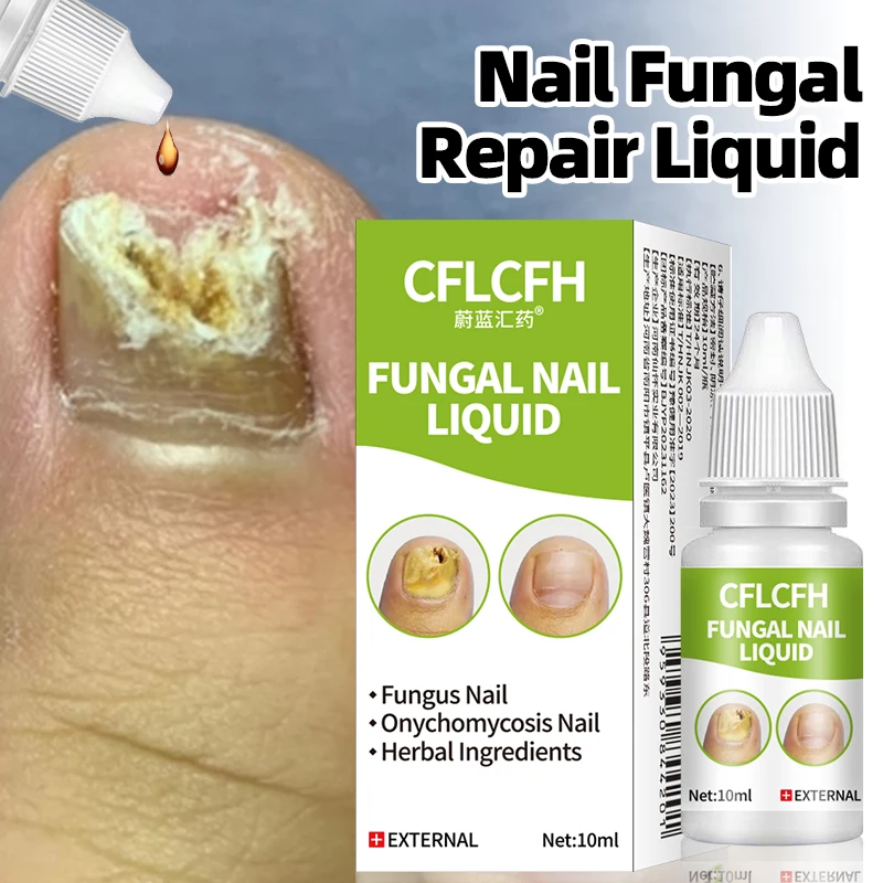 

Fungal Nail Repair Liquid Toe Fungus Removal Foot Care Onychomycosis Nail Treatment Anti Infection Paronychia Solution 10ml