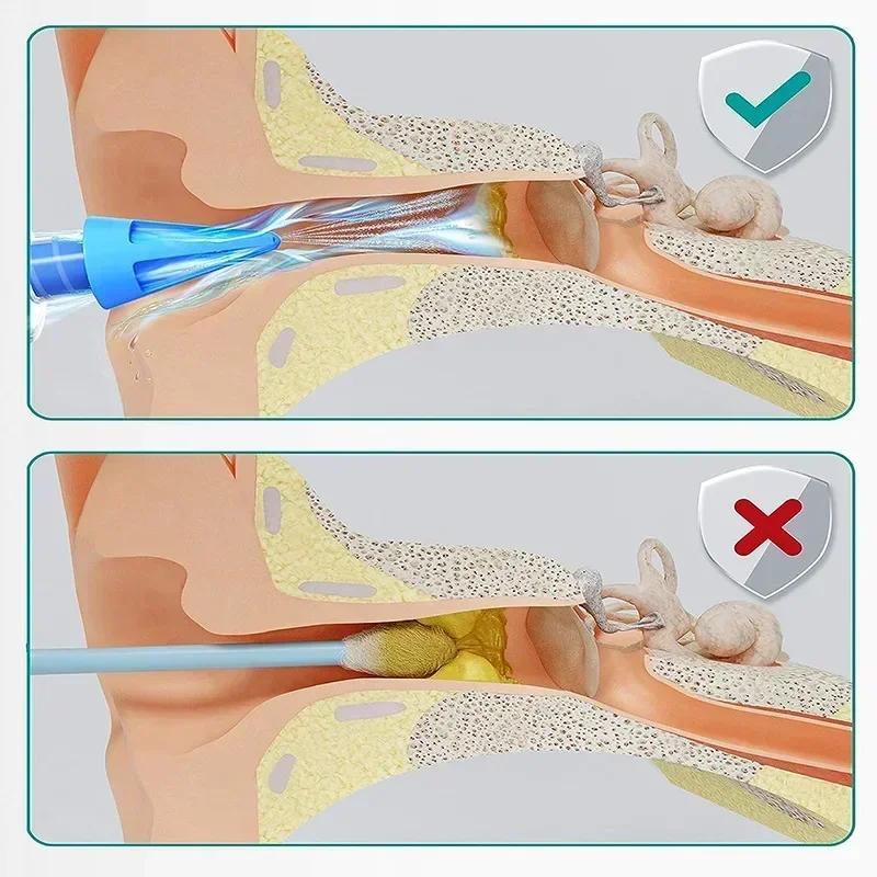 Description Picture 3 of item20ML 3-hole Ear Cleaner Syringe Irrigation Kit Ear Wax Removal Tool Earwax Washing Water Syringe Comfortable Unique Health Care