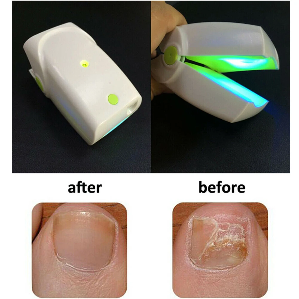 

NEW Home Use Toe Nail Fungus Laser Light Therapy Device Onychomycosis Anti Toenail Fungal Infection LLLT Physiotherapy