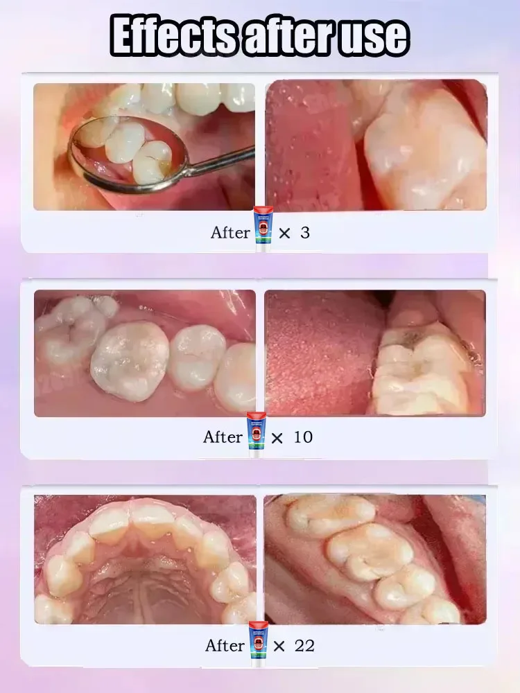 Teeth Health Product Tooth Decay Repair Cleans Plaque Whitens Teeth