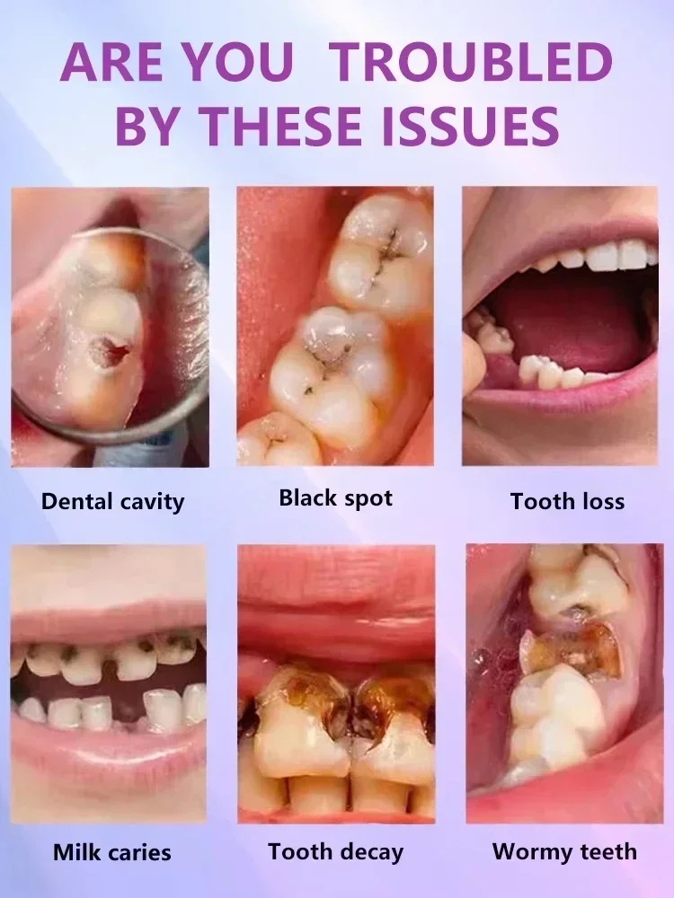 Anti Caries Repairing Cavities Tooth Decay Repair teeth health product
