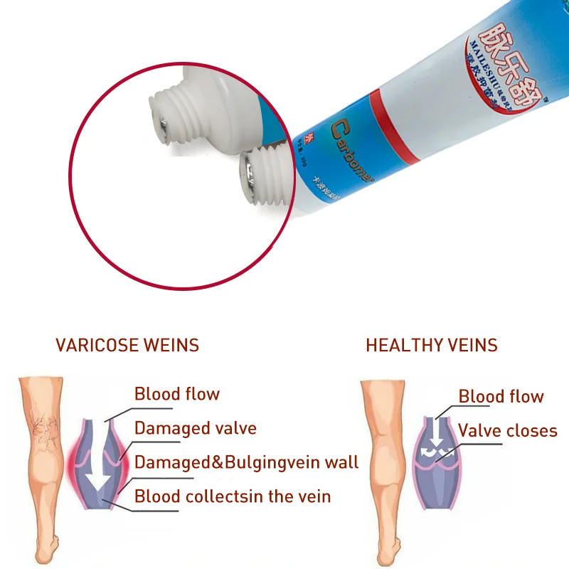 

Effective Varicose Vein Relief Cream Ointment For Varicose Veins To Relieve Vasculitis Phlebitis Spider Pain Treatment Plaster