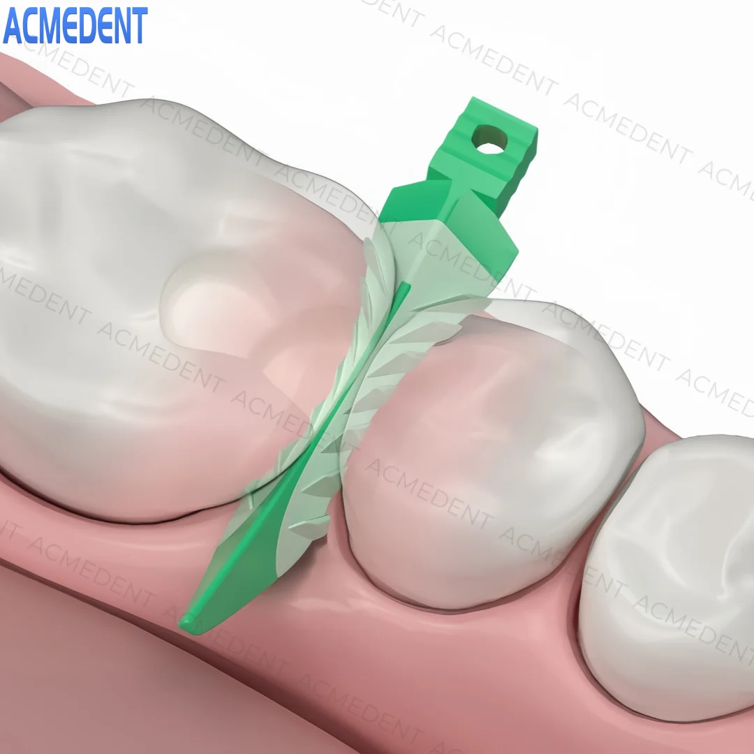 Coins Interdentaires Souples Dentaires - Pour Diastema, Scellement Composite