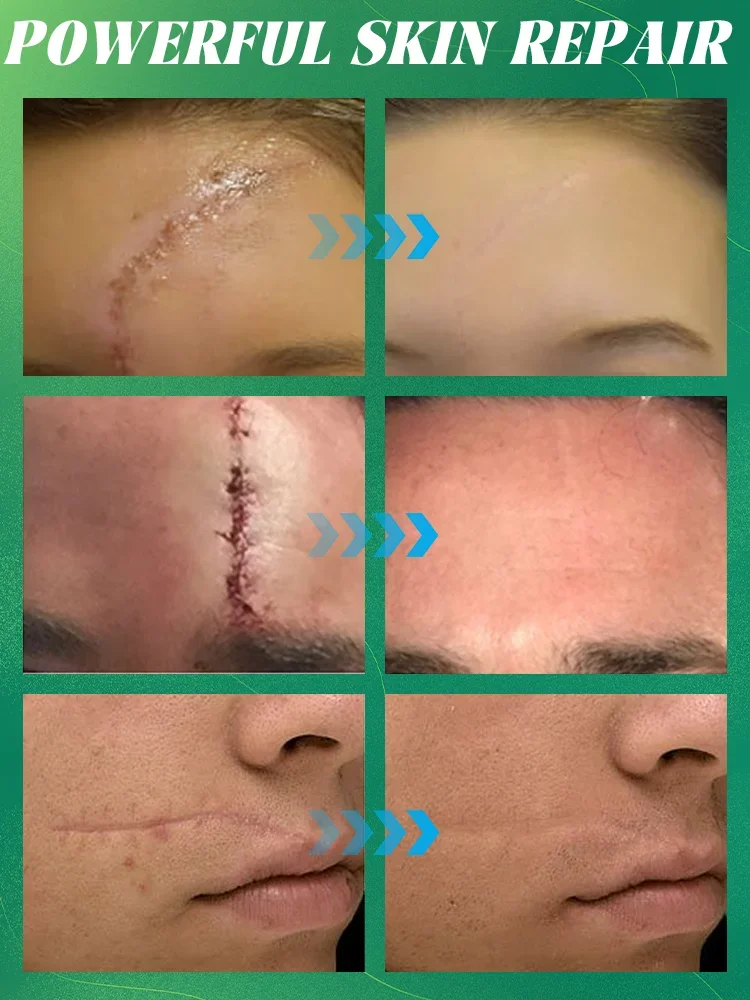 Scar removal, scar removal, burns and cuts, scar hyperplasia