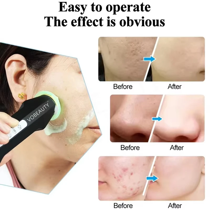 신형 휴대용 충전식 CO2 버블 펜 산소 캡슐 포드 피부 탄력 페이셜 머신 산소 페이셜 키트