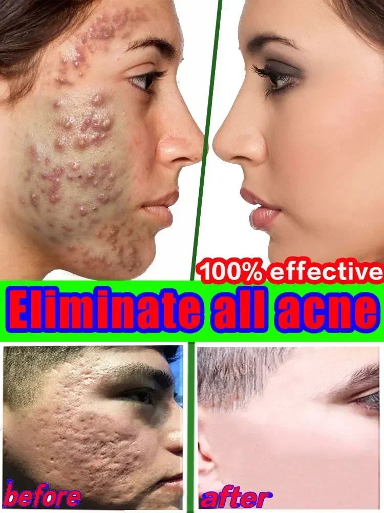 Salicylic Acid  Solution Essence Shrink pores and Acne Spot Removing Shrink Pores Oil-Control Brighten Face Skin Makeup 3