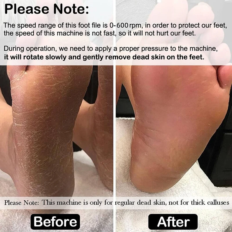 Electric Callus Remover For Smooth Heels Electronic Foot File_voghion.com