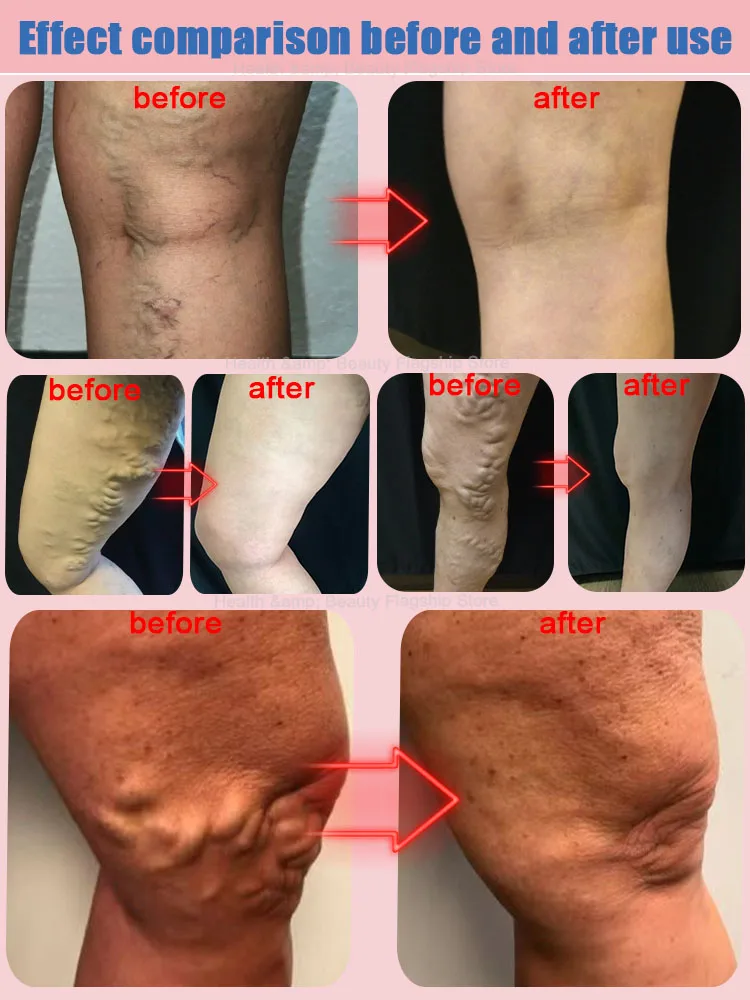 Varicose Vein Laser fractional co2 laser machine