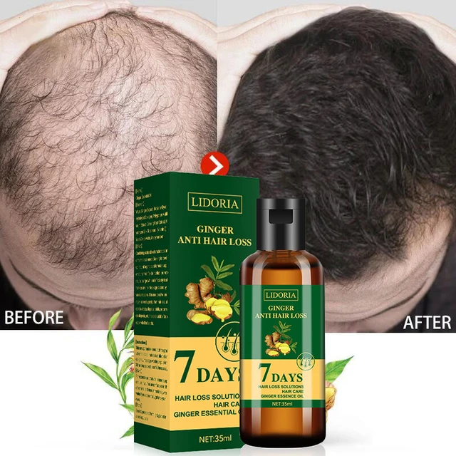 Óleo essencial natural anti perda de cabelo produtos rápido crescer impedir  calvície tratamento líquido germinal - AliExpress