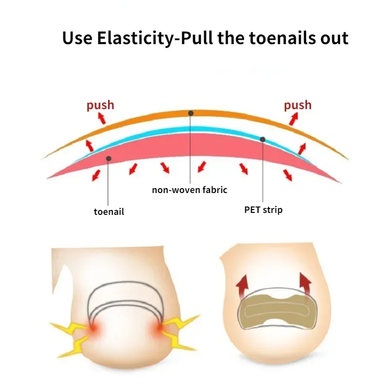 50/100PCS Foot Nail Repair Patch Grey Fungal Nail Thicken Soft Paronychia Infection Hand Nail Correction Sticker Ingrown Toenail