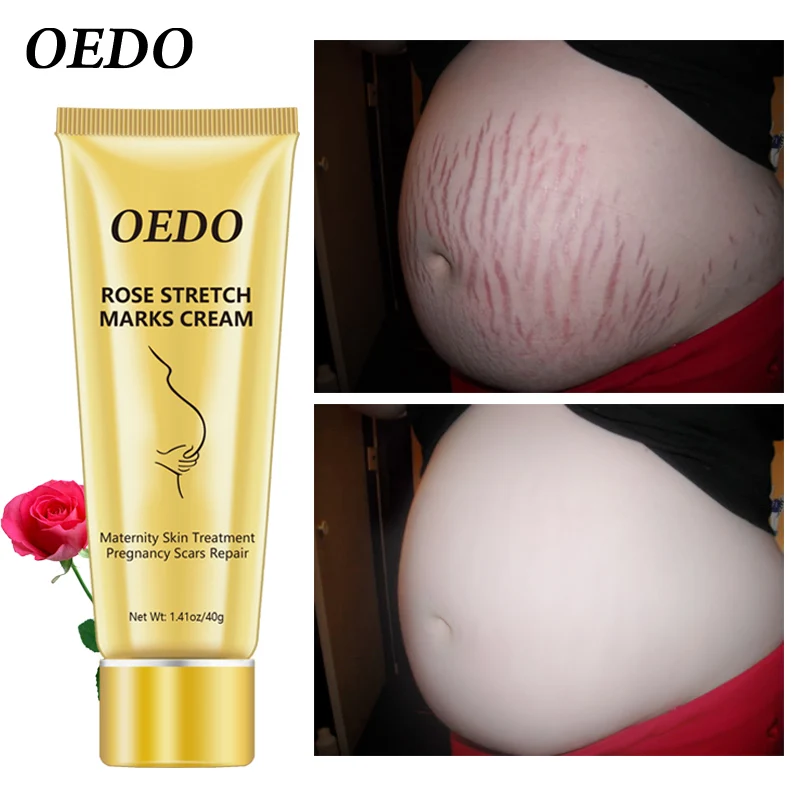 cara menggunakan oedo rose remove stretch mark cream