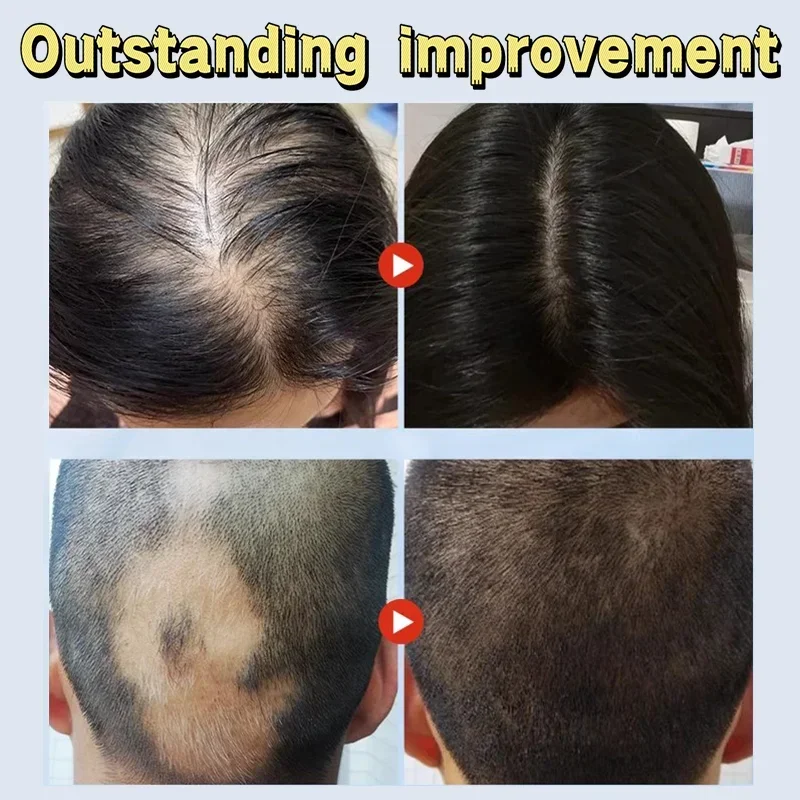 Reduces Hair Fall Nourishes the Scalp Powerful Hair Growth Serum Strengthens hair and adds shine Deeply moisturizes & nourishes