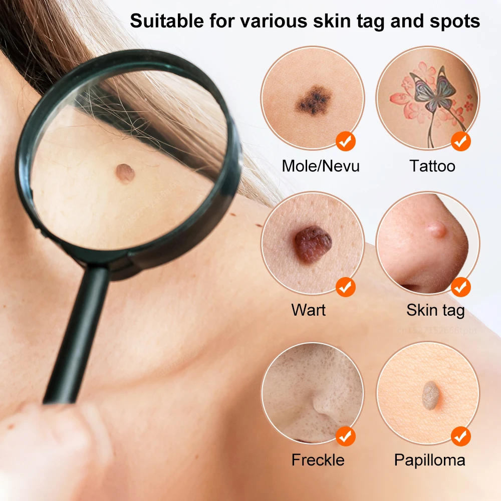 Laser Plasma Pen Skin Tag Remover