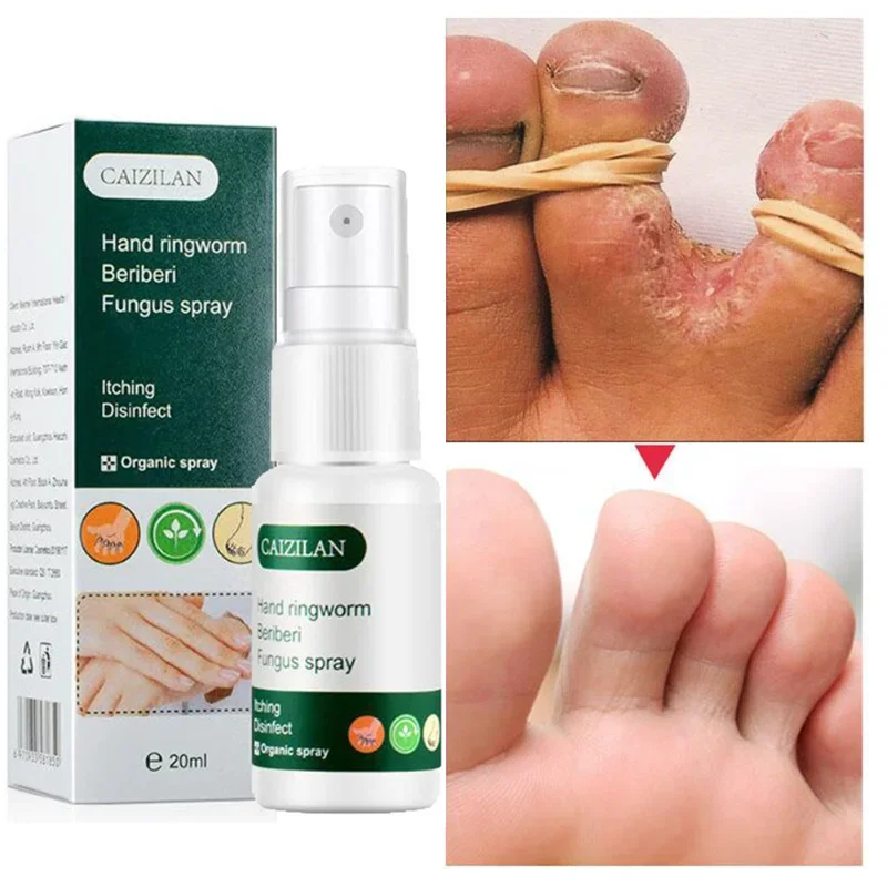 Nail Fungus Remover Pain Analgesic Cream Anti Fungal Spray Foot Fungus Cream For Cracked Heel Peeling Blister Repairing Feet
