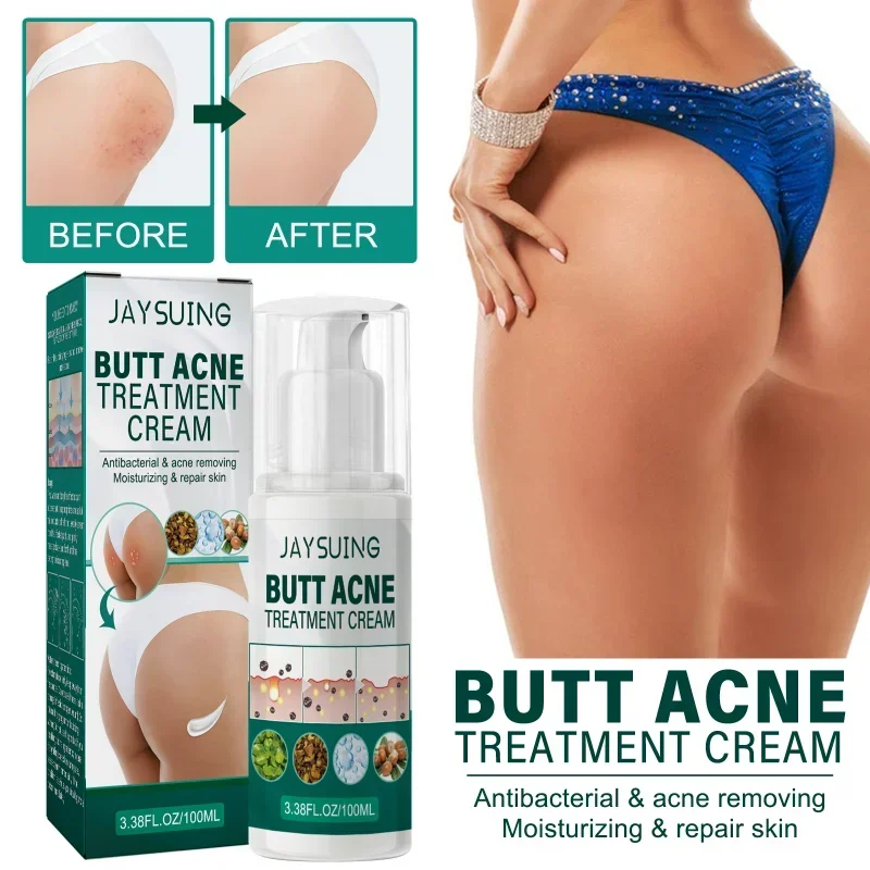 

Butt acne Treatment cream gentle repair nourish Hip dilute Pimple Scar Removal body Acne Spot Moisturizing tender skin care