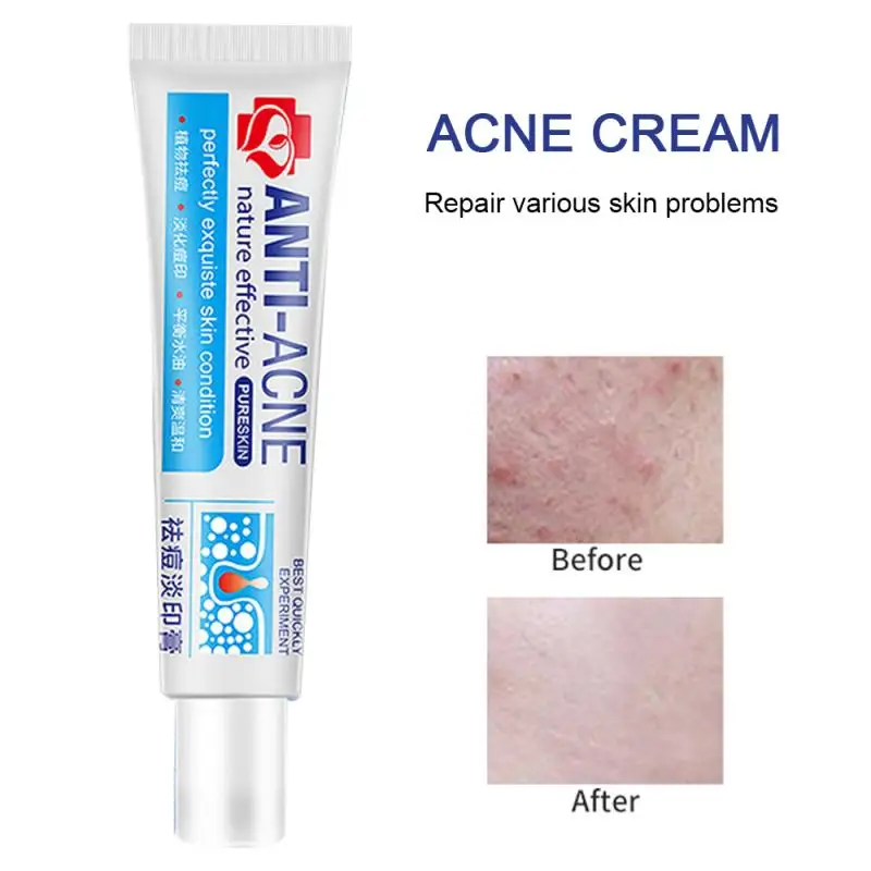 

Herbal Anti Effective Acne Removal Cream Traditional Chinese Medicine Treatment Shrink Pores Spots Gel Whitening Moisturizing