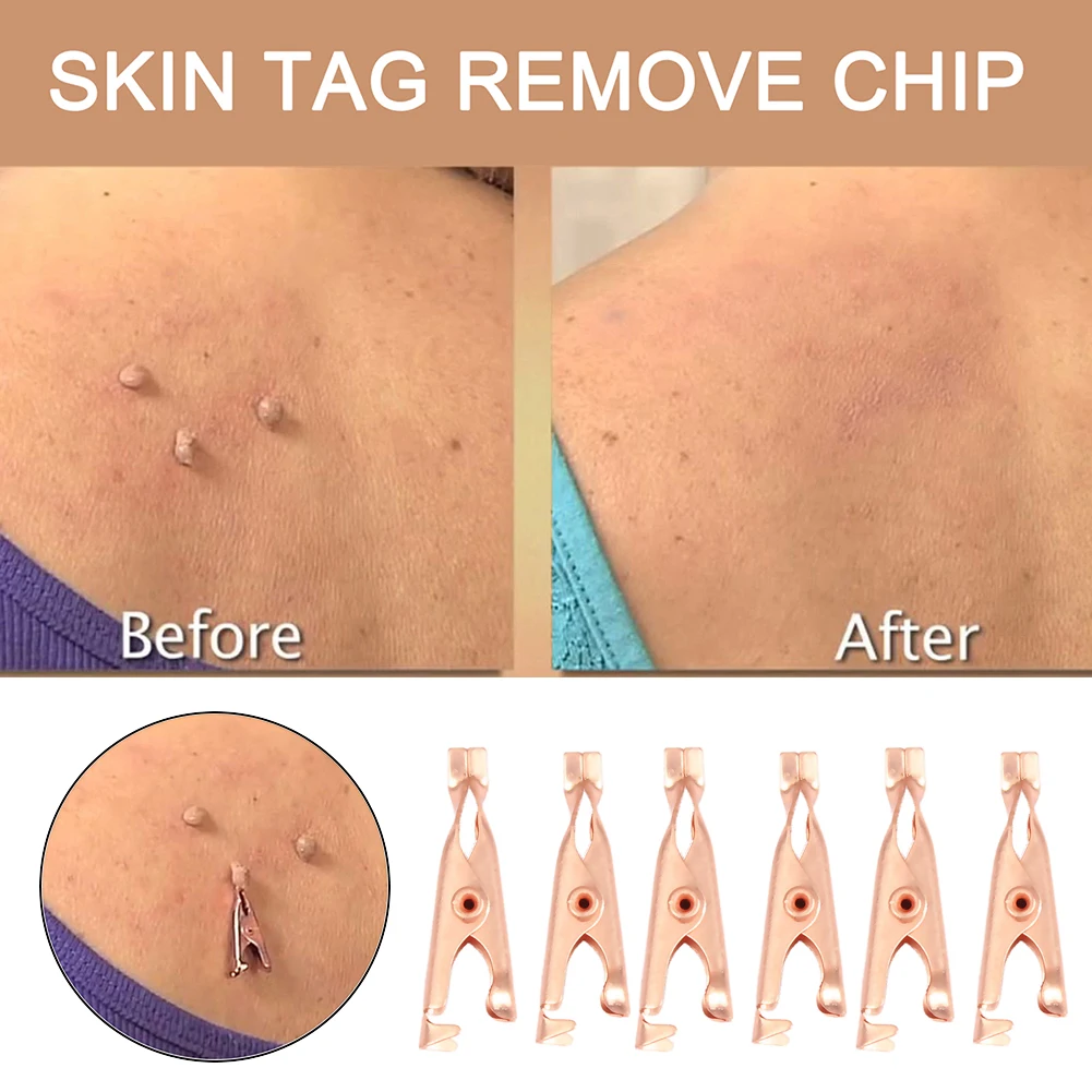 Painless Skin Tag Mole Wart Spot Removal Clips Body Warts Treatment Safe Foot Corn Removal Skin Care Clips Home Use