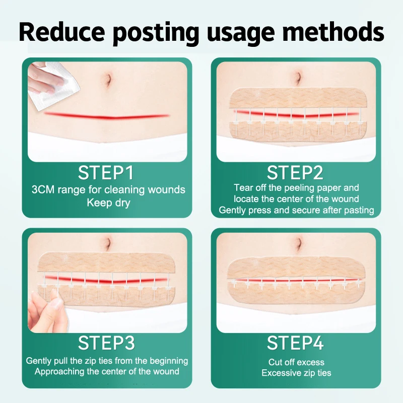 Band-Aid Zipper Tie Wound Closure Patch Hemostatic Patch Wound Fast Suture Zipper Band-Aid Outdoor Portable wound bandage,medical wound dressing,tattoo adhesive bandages