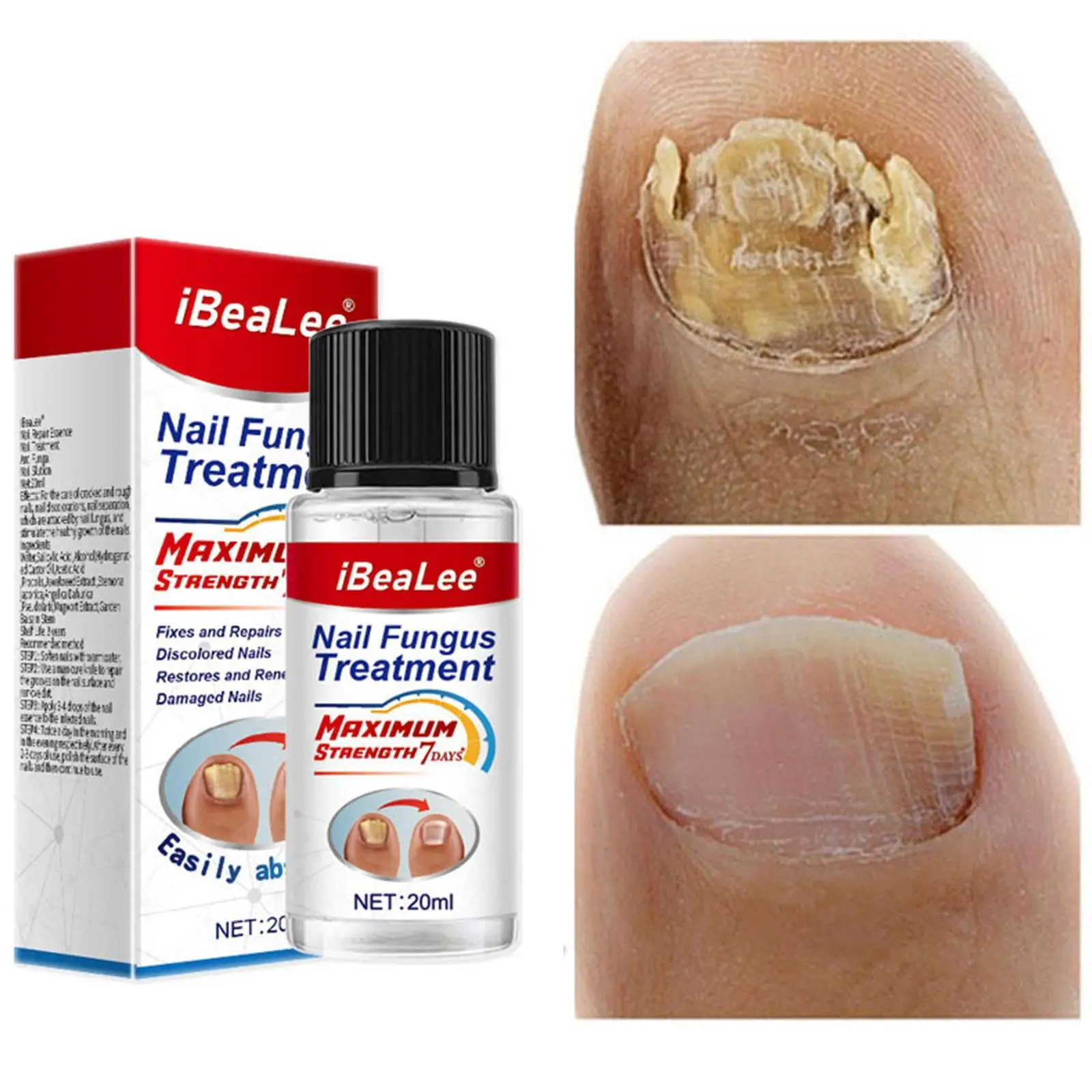 

100% Original Nail Fungus Treatment 7DAYS Repair Feet Care Essence Anti Infection Onychomycosis Foot Toe Nail Fungal Removal Gel