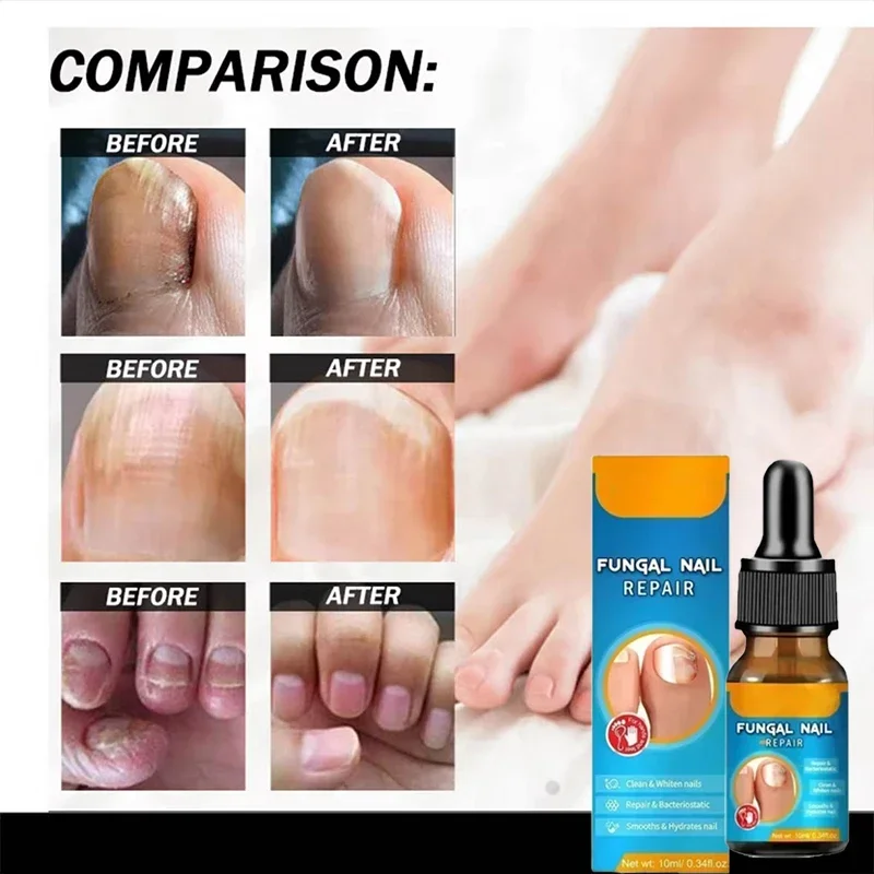 fungus nail treatment Nail Pain Reliever Nail Fungal Treatment Feet Care Essence Anti Infection Paronychia Onychomycosis