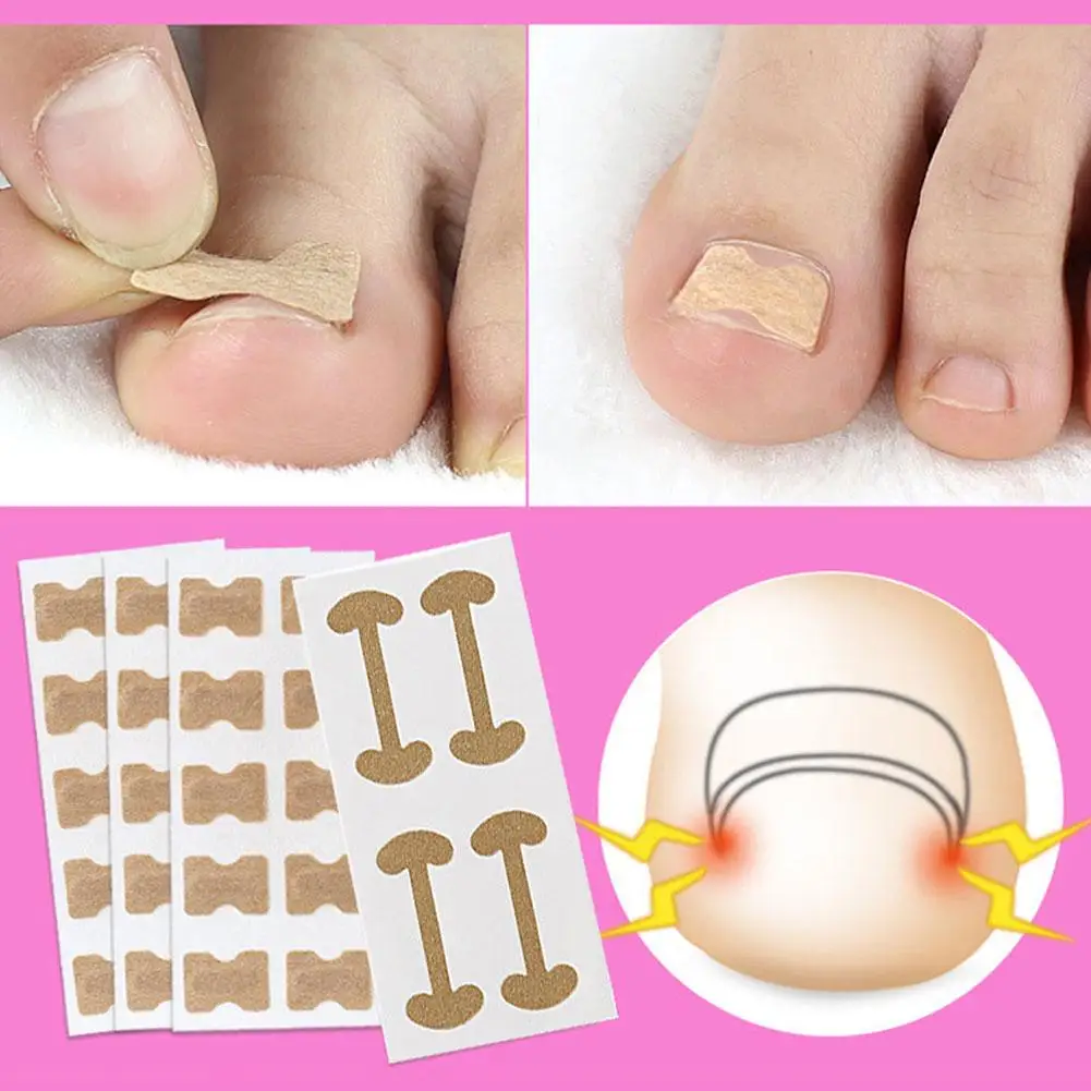 Kit correcteur d'ongles incarnés avec bandes correctrices, coupe-orteils, lime et outil de soin des pieds_voghion.com