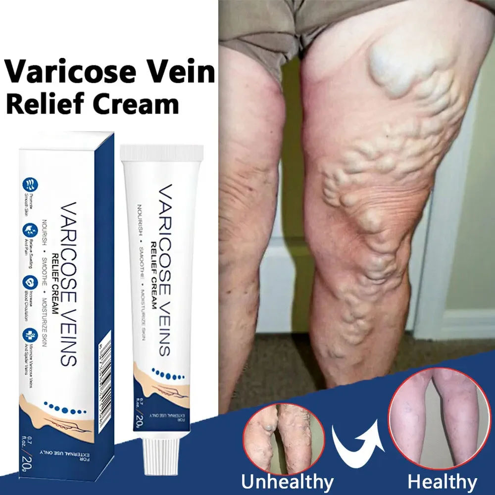Jemeesen Effective Varicose Veins Cream Relieve Vasculitis Phlebitis Spider Pain Relief Ointment Herb Plaster Beauty Body Care