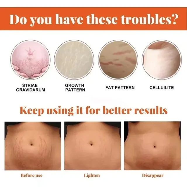 Stretch Mark Repair Cream – Smooth, Firm & Restore Skin Fast