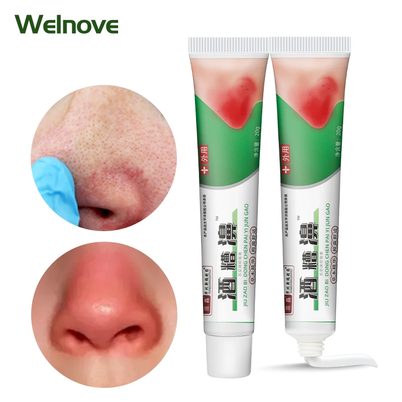 1pc 20g Rosacea Treatment Cream Acne Mites Rosacea Cream Remove Nose