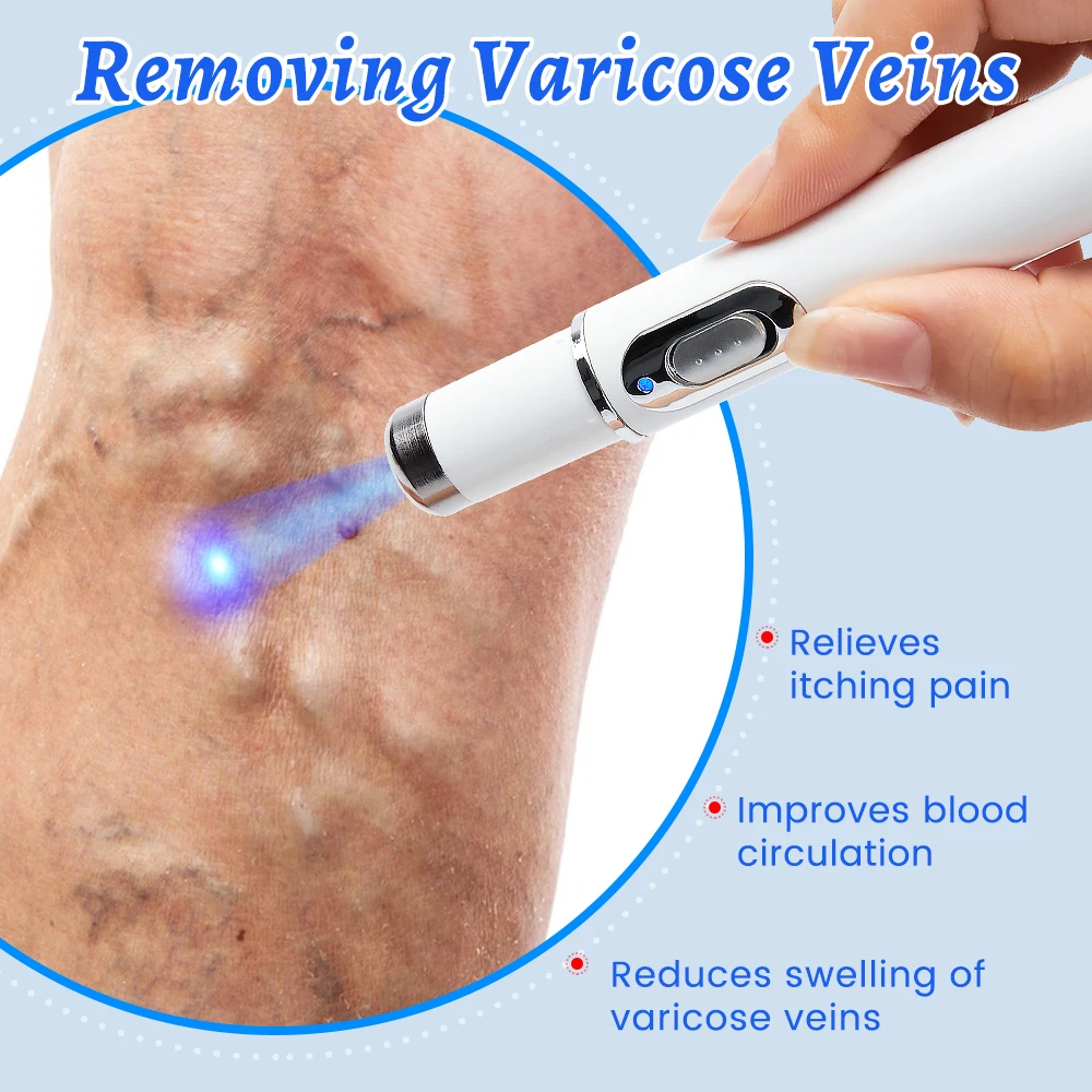 Varicose Vein Lampshade Therapy Effective Improved Blood Circulation Relief of Dilated Vasculitis In The Legs Phlebitis