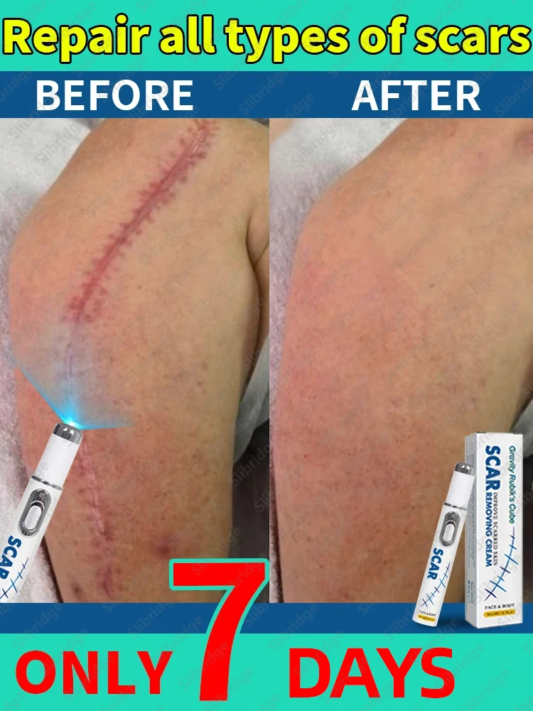 scar laser remover professional