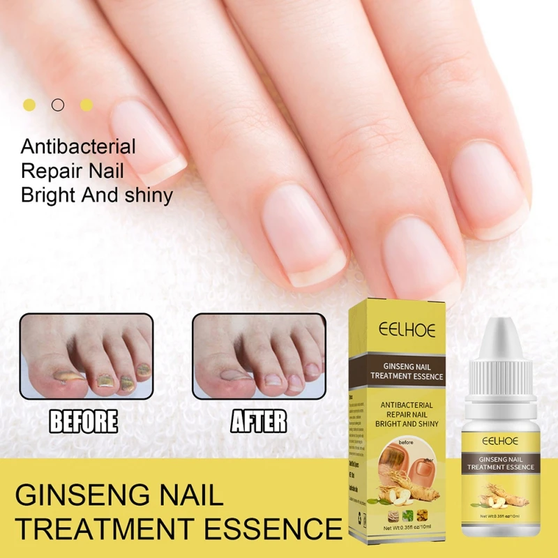 10ml Nails Fungus Damage Treatment Oil Stop Itching Bright Shine Dry  Strengthen Cuticles Fix Renew Health Skin Care - Nail Treatments -  AliExpress