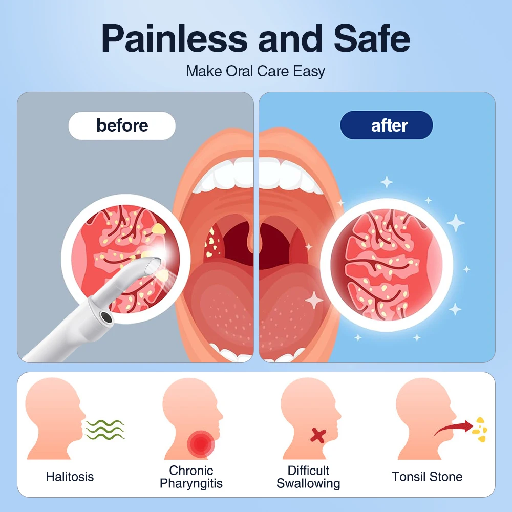 Electric Visible Vacuum Tonsil Stone Remover Kit with 3 Suction Modes Oral Care Tool for Tonsil Stones Removal Oral Fresh Care