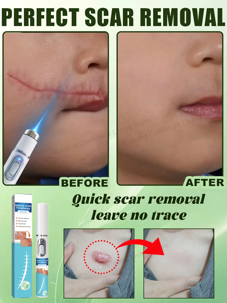 Laser scar repair 3