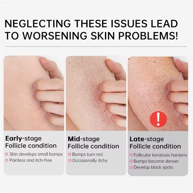 New Chicken Skin Repair Cream Curing Keratosis Follicle Pilaris Remove Thick Pores Body Dark Spot Moisturize Smooth Skin Care 4