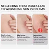 New Chicken Skin Repair Cream Curing Keratosis Follicle Pilaris Remove Thick Pores Body Dark Spot Moisturize Smooth Skin Care 4