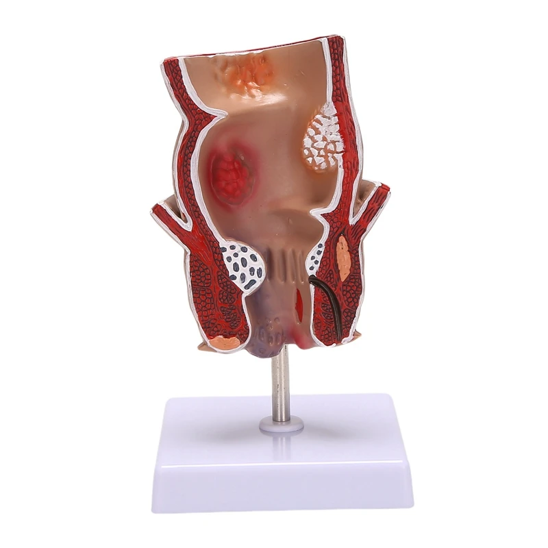 Anatomy Model Human Rectal Hemorrhoid Lesion Model Hemorrhoid Fistula Fistula Fissure Pathology Teaching Model 3