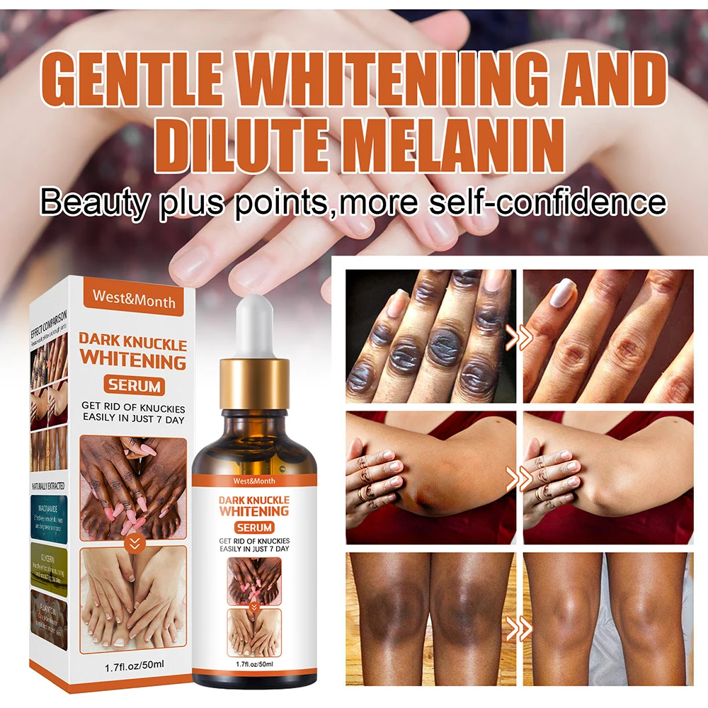 50 ml Aufhellungsserum, 7-Tage-Entferner, beseitigt dunkle Knie, dunkle Knöchel, Ellenbogen, Creme, Nikotinamid, hellt den Hautton auf. 2023 Neu_voghion.com