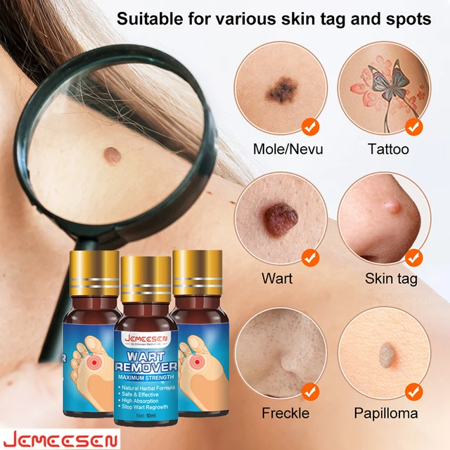 Jemeessen Szemölcs Eltávolító Fájdalommentes Szemölcsös Eliminátor Bőrcímke Szérumok Gyorsan Eltávolítja A Húsminta Mol Lipoma Verruca -T - Image 3