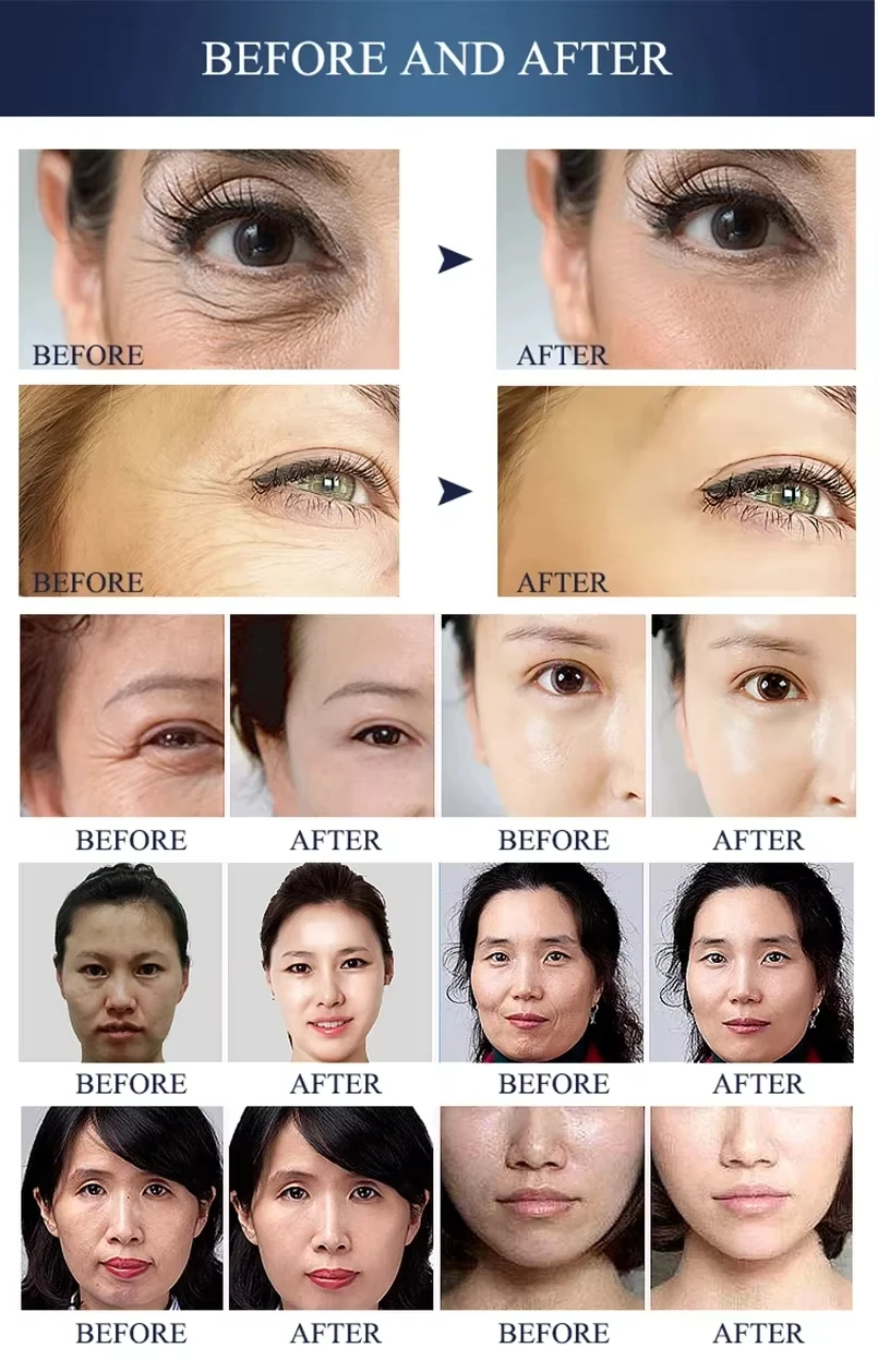 448khz Facial Lifting Weight Loss Machine Upgraded Radio Frequency Device Monopola or RF Skin Tightening body Rf Radio Frequency 6