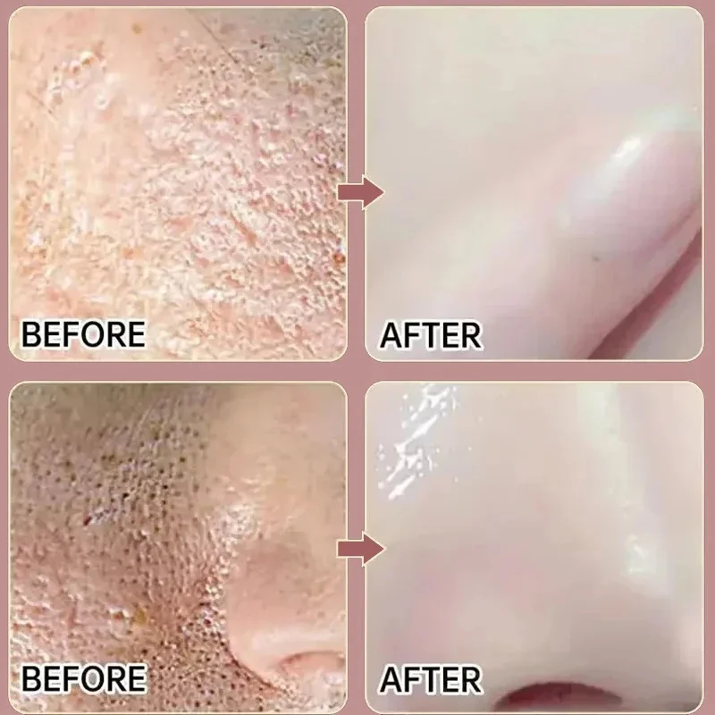 Description Picture 2 of itemOriginal Facial Remove Blackhead Niacinamide Solid Mask Treat Acne Blemish Black Dots Clean Stick Cream Shrink Pores Skin Care