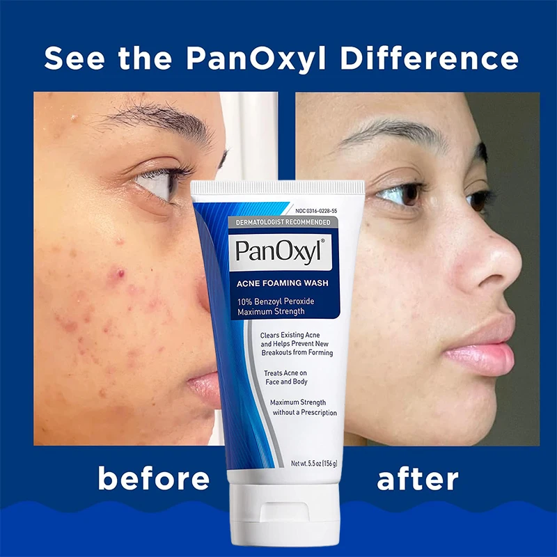 

156g PanOxyl 10% Benzoyl Peroxide Pore Deep Cleansing Foam Antimicrobial Hydrating Acne Blackhead Removal Facial Cleanser