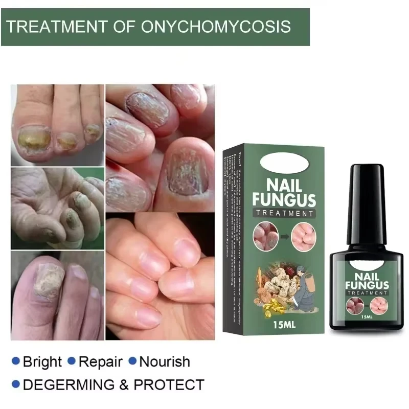 Nail Fungal Treatment Essence Oil Foot Toe Nail Fungus Removal Serum 7 Days Repair Onychomycosi Anti Infection Gel Care Products nail fungus remover