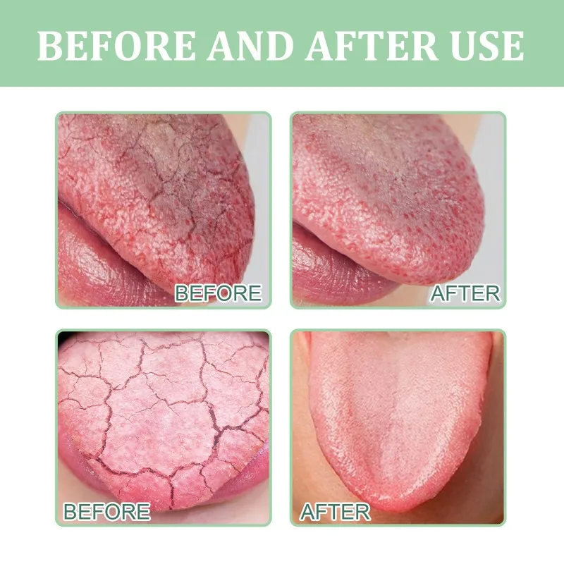 Fissured Tongue Relief Spray Teeth Clean Deodorant Prevent Calculus Remove Bad Breath Supplies Deodorizing Oral Spray 4